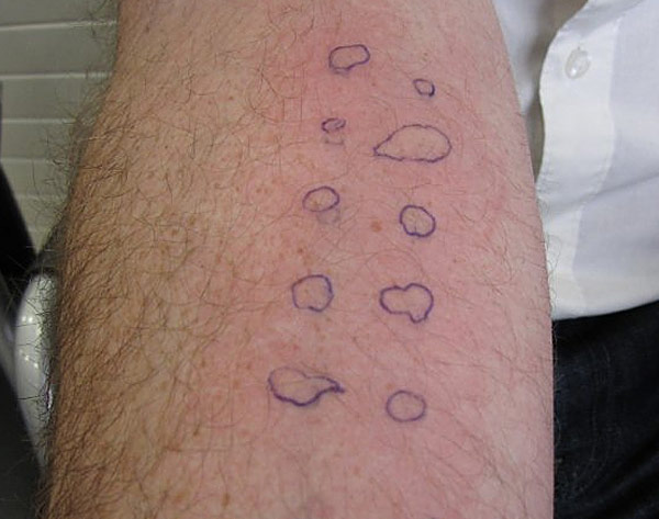 How positive allergy test reactions look