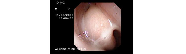 Nasal lining