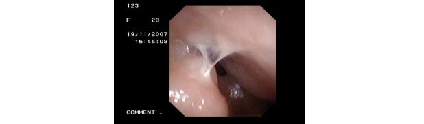 Nasal Lining